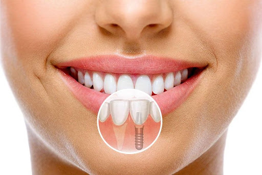 Современная имплантация зубов – комфорт и эстетика