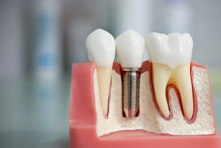Чтобы восстановить зубы нужна имплантация