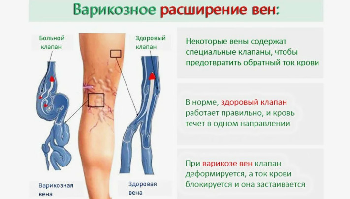 Варикоз вен на ногах: причины и лечение. Склеротерапия вен