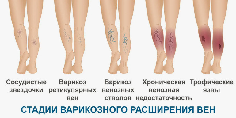 Варикоз вен на ногах: причины и лечение. Склеротерапия вен